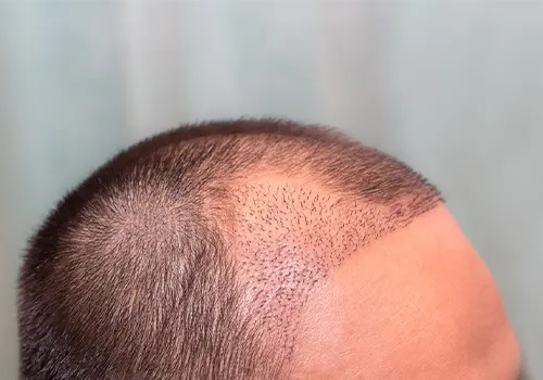 Hair Transplant for man