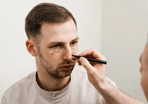 Revision rhinoplasty for man