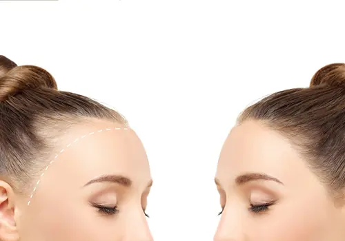 before and after Hair Transplant