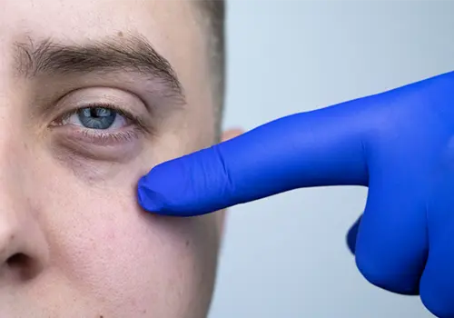 Eye Bag Removal