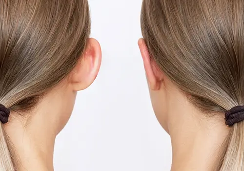 before and after ear correction