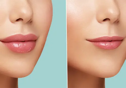  Non-Surgical Lip Augmentation 