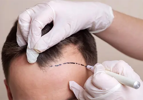 The Main Techniques Of Hair Transplant Surgery