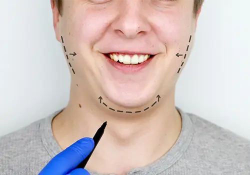 Chin Reshaping