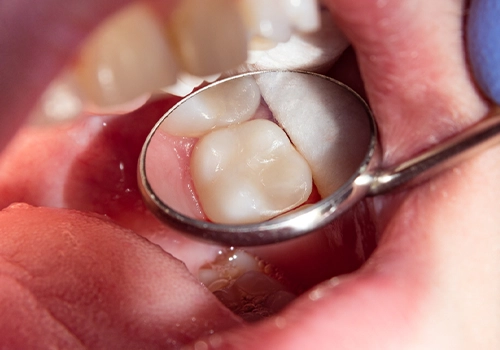  Amalgam Fillings