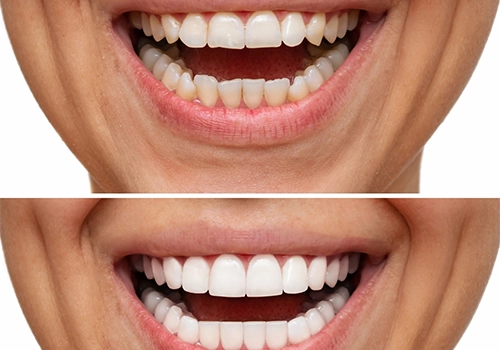 before and after Hollywood Smile