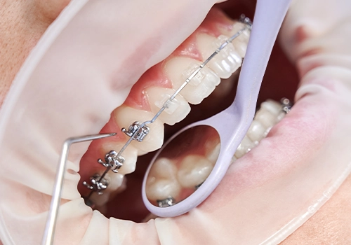 Orthodontics for Different Age Groups