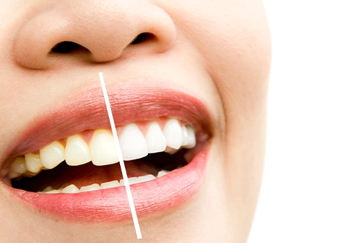  Tooth Whitening Risks and Side Effects